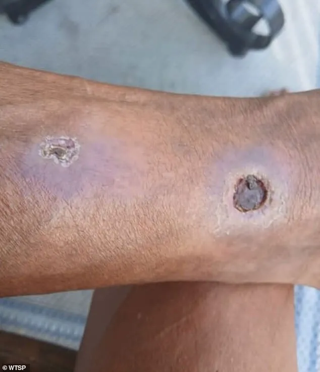 Late-Breaking: Florida Resident Sues Grand Oak Apartments Over Alleged Spider Infestation Negligence Leading to Amputation