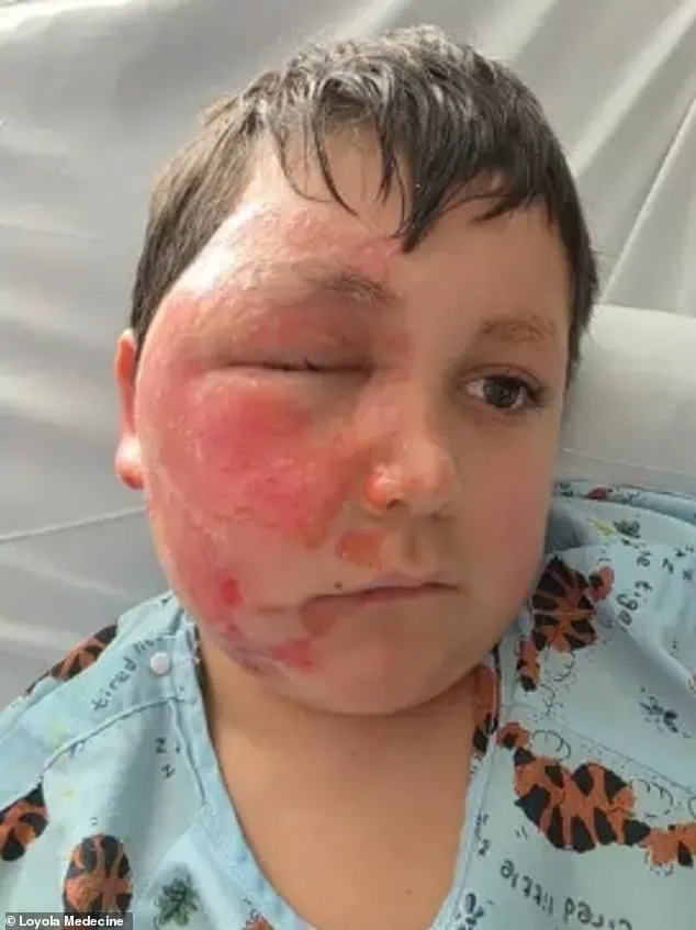Nine-Year-Old's Microwaving of Sensory Toy in TikTok Trend Causes Severe Burns