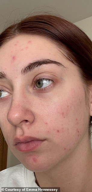Celebrities Turn to Microdose Accutane for Anti-Aging Benefits