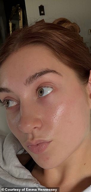 Celebrities Turn to Microdose Accutane for Anti-Aging Benefits