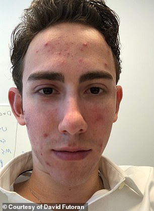 Celebrities Turn to Microdose Accutane for Anti-Aging Benefits
