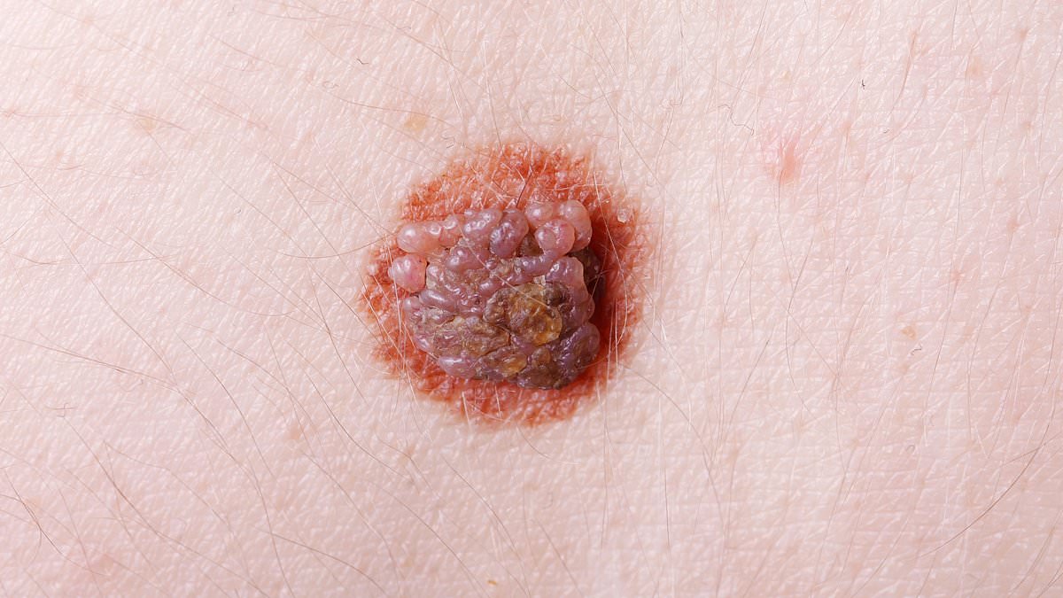 Global skin cancer cases expected to surge by 2050.