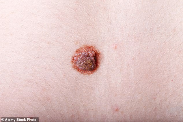Global skin cancer cases expected to surge by 2050.