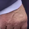 Public Concern Grows Over Unexplained Injuries on Trump's Hands: Calls for Medical Transparency and Expert Review
